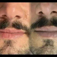 رفع تیرگی لب با بهترین متریال ماندگاری ۵سال