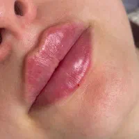 بوتاکس،فیلر،مزوصورت و مو، کاشت مو، فشیال