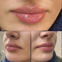 جشنواره ویژه تزریق ژل و مزو و پی آرپی درمطب|خدمات زیبایی و سلامت|اصفهان, نقش جهان|دیوار