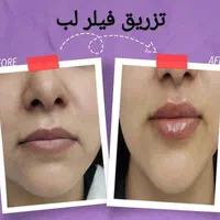 جشنواره خدمات زیبایی شامل هایفو و بوتاکس و فیلر