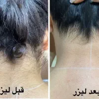 لیزر مو‌های زاید