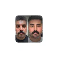 اموزش و تزریقات با جدید ترین متد فیلر و بوتاکس