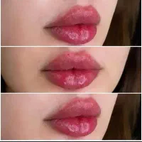 تزریق بوتاکس فقط 699 ژل(فیلر)فقط سیسی 600