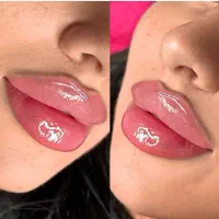 بوتاکس وژل ونخ