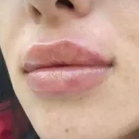 تزریق فیلر و بوتاکس برای زیباجویان