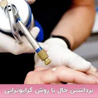 خال،زگیل کرایوتراپی فریز زگیل تناسلی شاهین ویلا