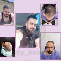 کاشت مو و ریش و ابرو ( ضمانت کتبی )