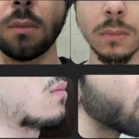 رویش مو و ابرو دوز بالا