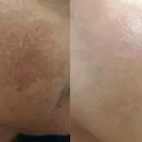 تکنولوژی بیوممتیک (ضدلک گاتیو)
