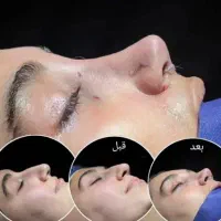 عمل بینی انجام بده فقط۴۵ میلیون دکتر نوید رنگزن
