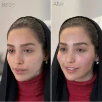 فول فیس فقط۷۹۰۰+بوتاکس فقط ۶۵۰ در مطب پزشک