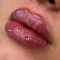 فیلر بوتاکس بلفا دایرکت