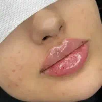 اف چربی ژل مزو نخ بوتاکس