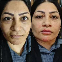 آموزش و خدمات بوتاکس فیلر فیشیال مدرک معتبر