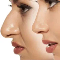 چسب لیفت و کوچک کننده بینی بدون جراحی