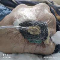 کارشناس و متخصص زخم بستر دیابت سوختگی عفونی تربت ح