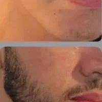 رویش ریش و سیبل و موی سر تضمینی