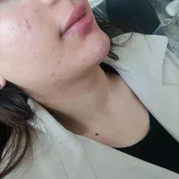 انواع فیلر و فیلر بادی تخصصی