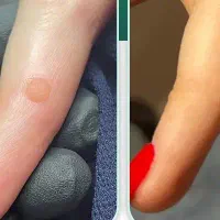 محل.ول مراقبتی موضعی زایی.دهه