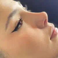 جراحی بینی با آف باورنکردنی در تهران