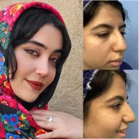 عمل جراحی بینی در تهران در جشنواره