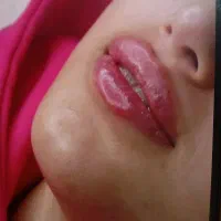خدمات زیبایی ولیزر