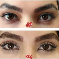 عمل بلفاروپلاستی درمان افتادگی پلک توسط متخصص چشم