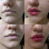 انجام تمامی خدمات فیلر و بوتاکس