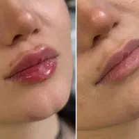 فیشال بوتاکس فیلر پی از پی مزوژل