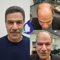 نژا کاشت مجموعه تخصصی کاشت مو و ابرو از سال 1383