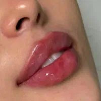 تزریقات زیبایی و جوانسازی در کلینیک