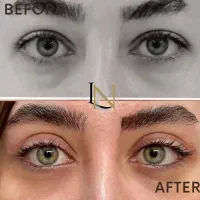 تخفیفات عمل زیبایی (گوش،پلک،ابرو ) بوتاکس