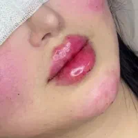 تزریق ژل و بوتاکس و پی آر پی و مزو و جوانساز