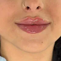 بوتاکس ژل  فیلر جراحی های زیبایی