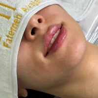تخفیف ویژه ژل بوتاکس انزیم  پرسینگ