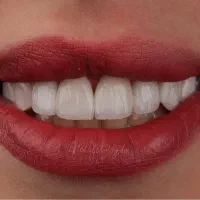 ایمپلنت فوری با اقساط بلند مدت/دندانپزشکی/ اوردنچر