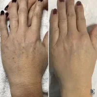 پک جوانساز دست و رفع لک