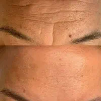 جایگزین بوتاکس و لیزر