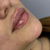 جوانساز،ژل لب و صورت،بلفاروپلاستی،بوتاکس صورت،