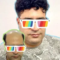 پروتز مو ماکروپوینت (کاشت موقت)