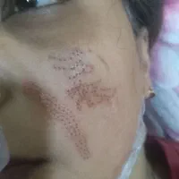پلکسر‌ خال زگیل میکرو ابرو تتو اپیلاسیون