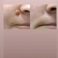 برداشتن خال و پاک کردن تاتو