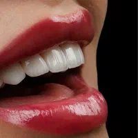 کامپوزیت اقساطی/روکش/لمینیت