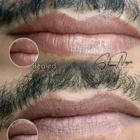 رفع تیرگی لب آقایان با روش تخصصی و نتیجه محور