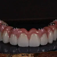 ایمپلنت و اوردنچر کره ای و آلمانی شرایط اقساط ویژه