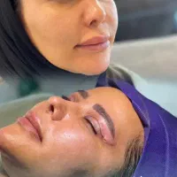 افتادگی پلک،تضمینی لیزری vipتیم جراح زیبایی پلک