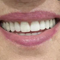 دندانسازی لبخند ماندگار دندان مصنوعی تضمینی