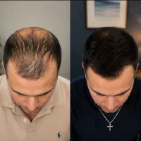تی سی روزه موهاتو پر پشت کن