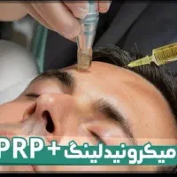 تخفیف ویژه برای پی آر پی‌‌ با بهترین نوع کیت خارجی