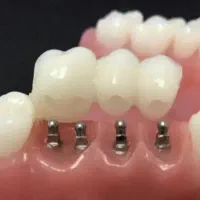 ایمپلنت دیجیتالی یک روزه با چک